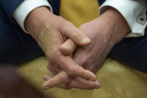 Trump Diagnosed with Chronic Venous Insufficiency, Docs Say